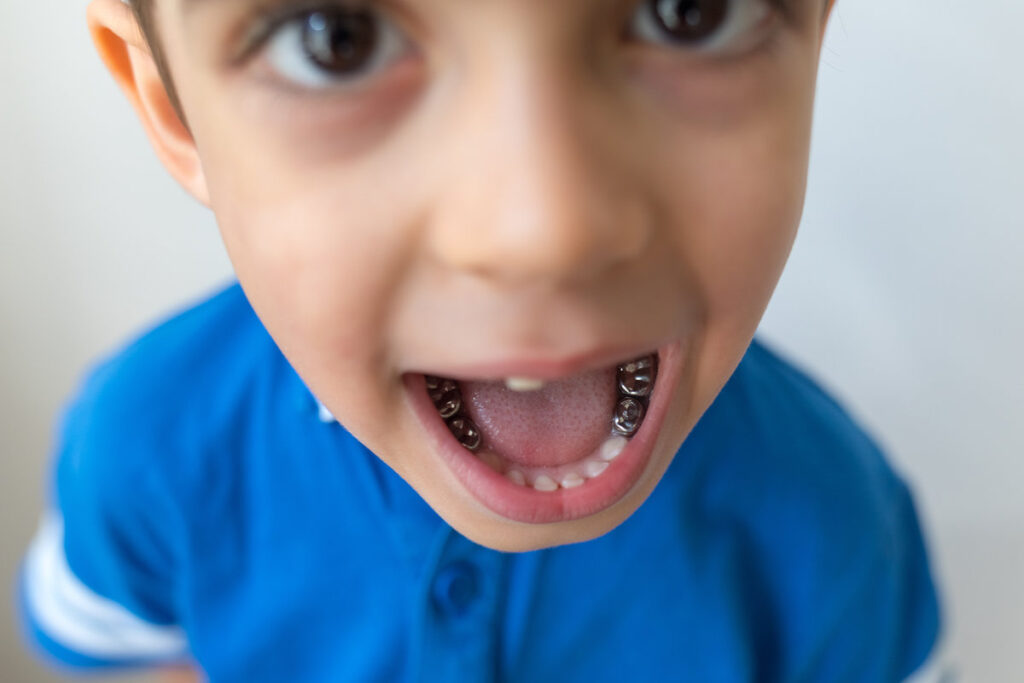 Dental care concept. Stainless steel crown a silver cap used for restoring children's teeth.