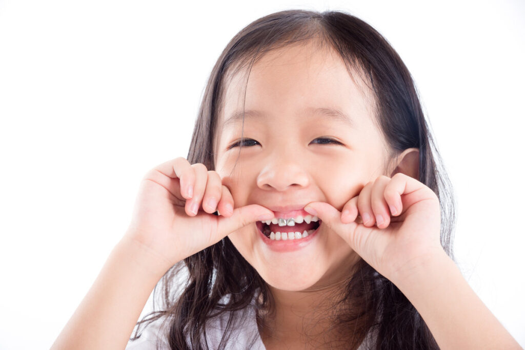 Young Asian girl child showing silver amalgam tooth sealant over white background