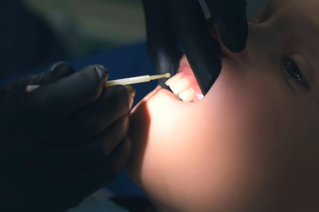 Doctor hygienist applying fluoride to teen teeth with cotton swab in dentistry. Covering using fluoride gel. Cure concept. Dentist making fluoridation child boy teeth after cleaning for protection.